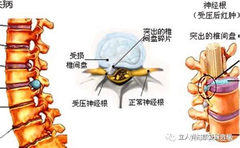 治疗腰间盘突出，微创手术怎么样？ 知乎