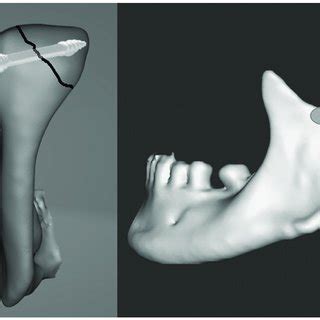 Typical Fixation Of The Mandibular Head With The Exemplary Headless