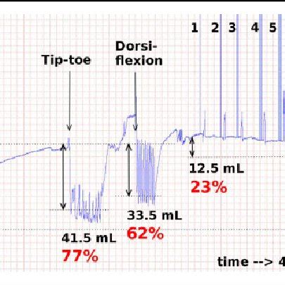 Volume Versus Time Apg Tracing Comparing The Reductions In Calf Volume