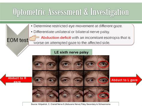 Sixth nerve palsy | PPT