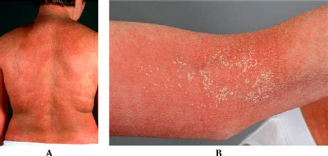 Acute Generalized Exanthematous Pustulosis Semantic Scholar