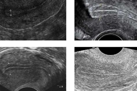 Thicken Uterine Lining 2 Powerful Treatments That Work