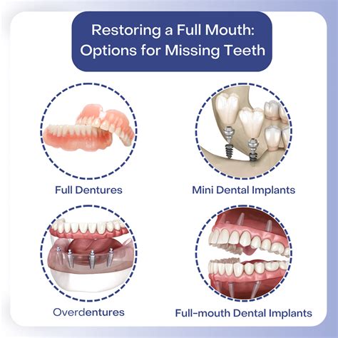 Full Mouth Dental Implants East Bronx Dental Implants In New York