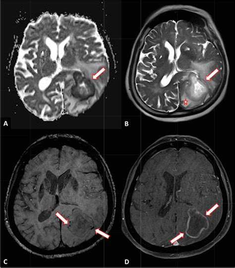 MRI demonstrates left parieto-occipital space occupying lesion. On DWI ...