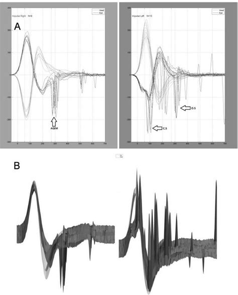 Figure From Comparison Of Vestibulo Ocular Reflex Instantaneous Gain