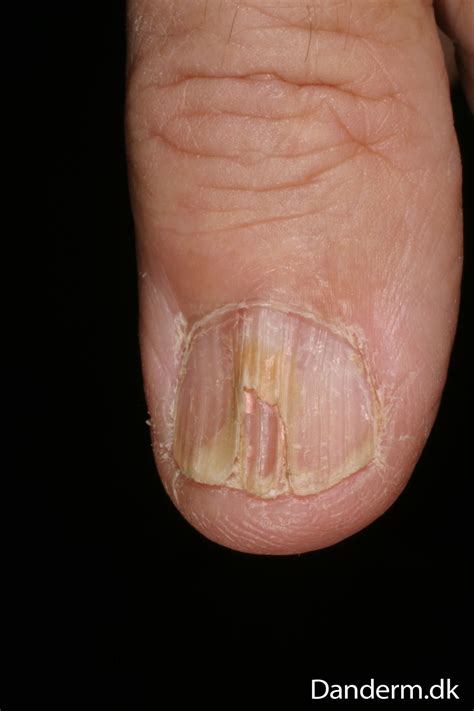 3 119 21 Lichen Planus Of A Nail