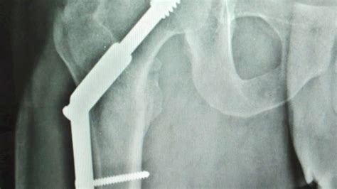 Cirugía De Rodilla Y Cadera En Guadalajara Osteosintesis De Cadera