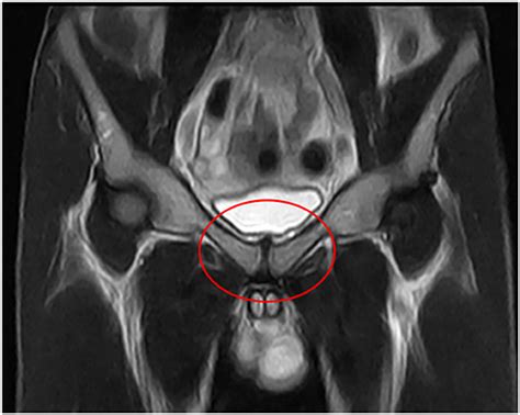 Adductor Tendon Mri