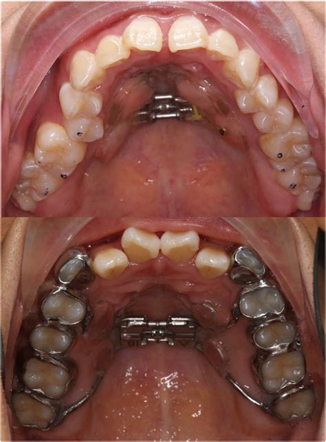 Treatment Effects After Maxillary Expansion Using Tooth Borne Vs Tissue