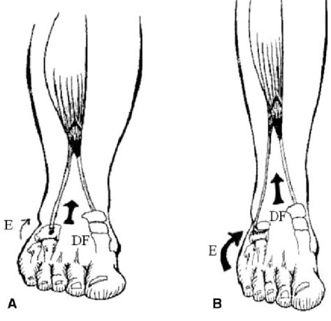 Anterior Tibialis Tendonitis