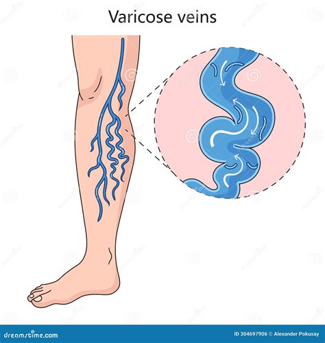 Varicose Veins Diagram Medical Science Stock Illustration