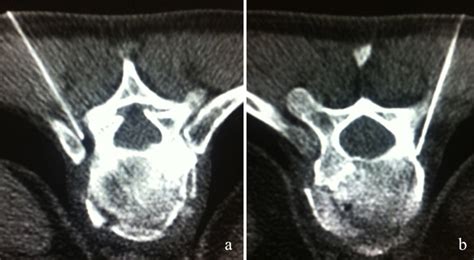 Vertebral Split Fractures Technical Feasibility Of Percutaneous