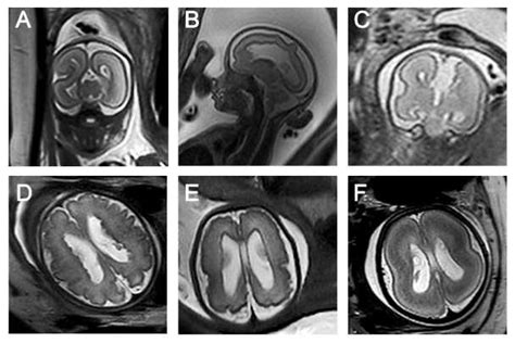 Six Cases Of Prenatal Mri With Cortical Formation Abnormalities Of The