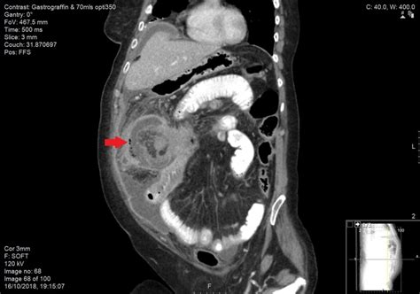 Diagnostic Challenge Of The Non Specific Presentation Of Adult Intussusception Bmj Case Reports