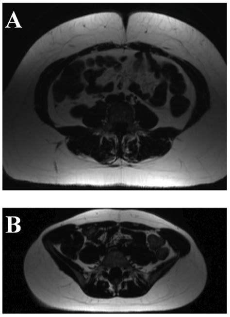 Visceral Fat Mass Images from A) Obese (BMI 37.3 kg/m2) and B) Normal ...