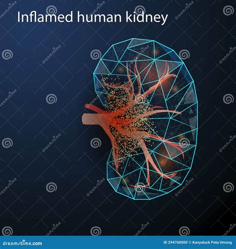 Polygonal Vector Illustration Of An Inflamed Human Kidney On A Dark