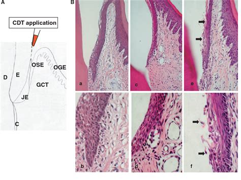 Figure 1 From Topical Application Of Aggregatibacter