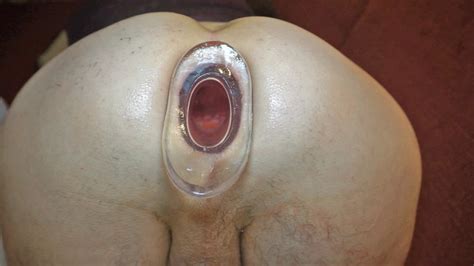 Giant Anal Tunnel Up To Cm Diameter In My Asshole Pics XHamster