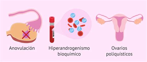 Cómo se diagnostica el síndrome de ovarios poliquísticos