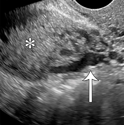 Imaging Appearance And Nonsurgical Management Of Pelvic Venous