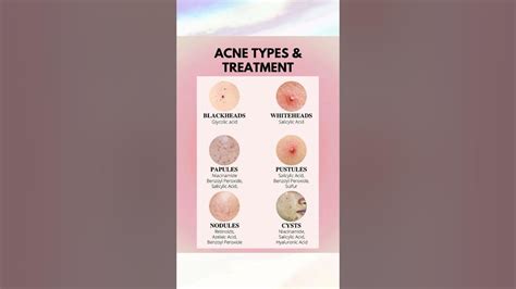 🌸what Is Your Acne Telling You 🌸♡°• Dearmygirls Acne Pimple