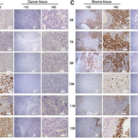 Hbsag Was Downregulated In Hcc Tissues Compared To Tumor Periphery A