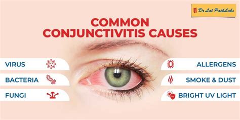 Symptoms of Conjunctivitis Archives | Dr Lal PathLabs Blog