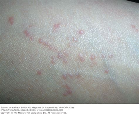 Lichen Planus On Wrist