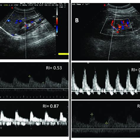 The tardus et parvus waveform in a patient with renal artery stenosis ...