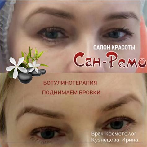РАБОТА МАСТЕРА. БОТУЛИНОТЕРАПИЯ. Поднимаем бровки. #косметология # ...