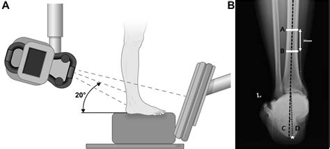 Intraoperative assessment of hindfoot alignment using C-arm fluoroscopy ...