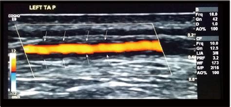 Temporal Artery Ultrasound