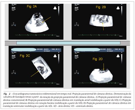 Scielo Brasil Valvuleta De Eust Quio Imagem Ecocardiogr Fica