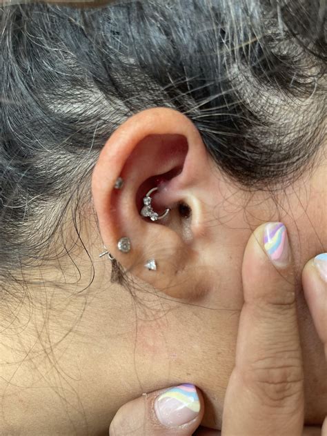 Daith Piercing Bumps Wont Go Away More Info In The Comments R