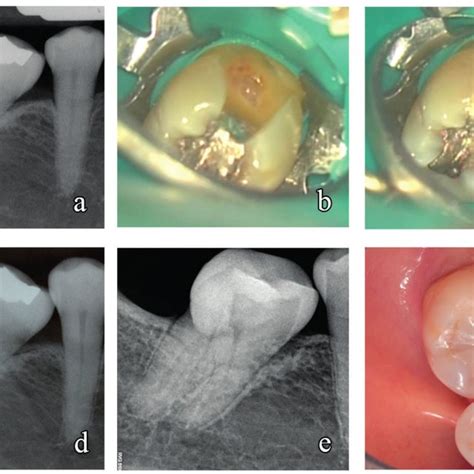 Partial Pulpotomy On Tooth A Preoperative Radiograph Showing That