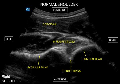 Shoulder Ultrasound Anatomy