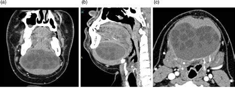 Floor Of Mouth Cystic Lesion Ct Viewfloor Co