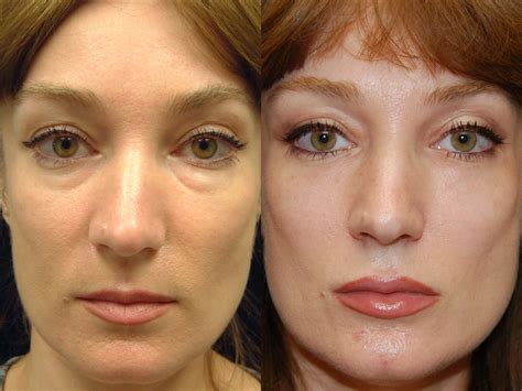 Before and after tear trough fillers | Cosmetic/Plastic Surgery