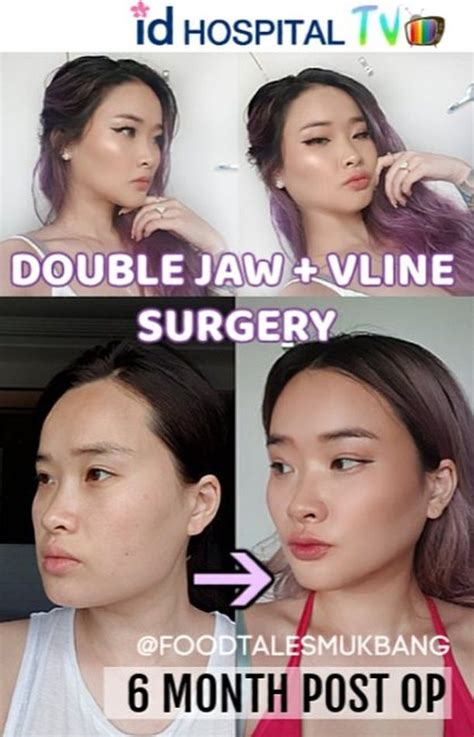 Orthognathic Double Jaw V Line Surgery 6 Months Review Jaw Surgery