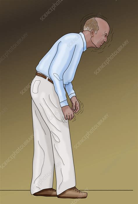 Man With Parkinson S Illustration Stock Image C027 7355 Science