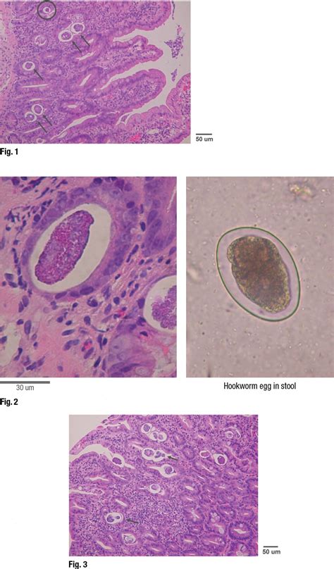 Parasites In Tissue How To Identify The Structures Cap Today