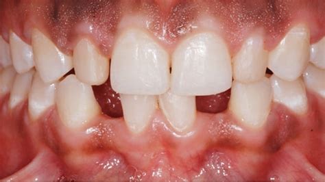 Management Of Peg Shaped Maxillary Lateral Incisors And Congenitally