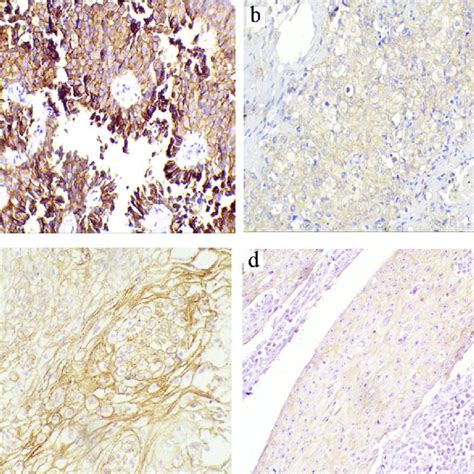 Representative Immunohistochemical Staining Of E Cadherin In Tccs And Download Scientific