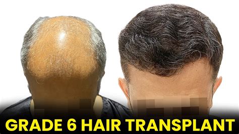 Hair Transplant For Complete Baldness Grade 6 5500 Grafts