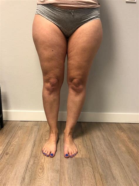 Review Lpg Behandeling Bij Cellulite Resultaten En Voor En Na Fotos