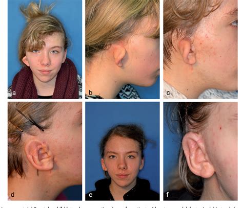 Figure From The Rib Cartilage Concept In Microtia Semantic Scholar