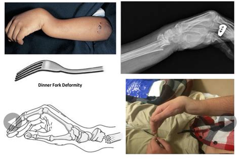 Colles Fracture