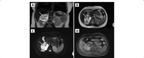 A T Weighted Coronal View B T Weighted Axial View C Fat