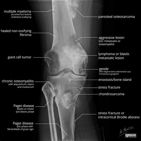 Benign Bone Tumor Hot Sex Picture