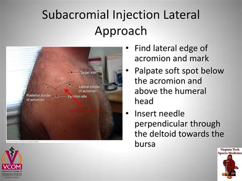 Subacromial Injection Lateral Approach